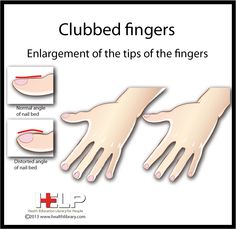 Clubbed Fingers Clubbed Fingers, Lady Fingers, Contouring And Highlighting, Health