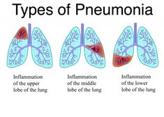 Walking pneumonia: Who is at risk? How common is atypical pneumonia ...