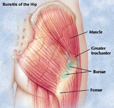 Hip Bursitis - Trochanteric Bursitis · Musculoskeletal Issues articles | Body & Health Conditions center | SteadyHealth.com Sciatica Pain, Massage Techniques, Reflexology, Massage Therapist