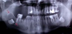 Dentaltown - Cyst around impacted wisdom tooth. Impacted Wisdom Teeth, Oral Pathology, Wisdom Tooth, Dental Website, Dental Humor