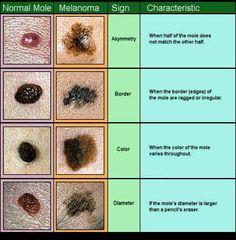 Normal Moles vs Melanoma. Skin cancer...what to look for.  Have your doctor check suspicious moles. I got this from a friend on facebook. Nursing Mnemonics, Being A Nurse, Health Heal, Good Things To Know, Integrative Medicine, Holistic Nutrition, Healthy Beauty, Alternative Health, Health Facts