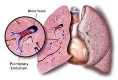 Pulmonary Embolisim story board