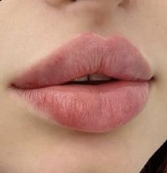 Botox Lips, Lip Injections, Foto Baby, Nose Job, Lip Fillers