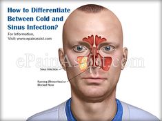 How to Differentiate Between Cold and Sinus Infection? Blocked Nose, Sinus Infection, Carnival Face Paint, Anatomy