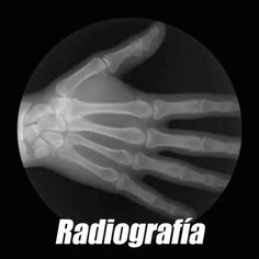 the radiograph shows an x - ray of a hand