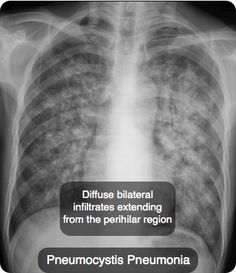 This patient presents with symptoms and a chest X-ray consistent with ...