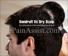 Dandruff Vs Dry Scalp: Basic Differences Moisturizing Hair Mask, Coconut Oil Hair Mask, New Hair Growth, Coconut Oil Hair, Dry Scalp, Dandruff, Hair Mask, Hair Growth, New Hair