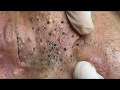 Enjoy Your Day With Hien Nguyen Spa # 1160 - YouTube Blackheads Popping Videos Nose, Black Heads Removal Videos Youtube, Clean Pores Videos, Black Heads Removal Video, Nose Pimples, Covering Acne, Stamping Techniques Card Tutorials, Easy Homemade Biscuits, Gross Stuff