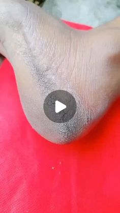 Pihu officials on Instagram: "Repair Cracked Heels In 1Day | Get Rid Of Cracked Heels   . . . #heels #cracked #repaircrackedheels #heels #feet #feetcare #trendingreels #instagood #instagram #viralvideos" Dry Heels How To Get Rid Of, Foot Soak For Cracked Heels Diy, Heal Cracked Heels, Cracked Heel Remedies, Lip Care Tips, Dry Cracked Heels, Dry Heels, Health Hacks, Home Health Remedies