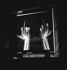 an x - ray image of two hands holding each other in front of a tv screen