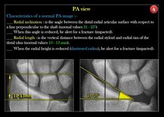 Wrist Xray, Radius Bone, Medical Radiography, Radiology Student, Normal Values, Bells Palsy, Diagnostic Imaging, Rad Tech, Human Anatomy And Physiology