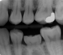 Ankylosis Bitewing X-ray Teeth Images, Dentist Assistant, Dental Education, Dental Posts, Rare Disorders, Dental Marketing, Tooth Pain, Family Dental, Dental Procedures