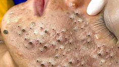 Blackhead Extraction, Pimples On Face, Black Heads, Acne Treatments, Cystic Acne, Most Satisfying, Skin Care Treatments, Blackhead Remover