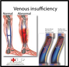 Venous Insufficiency Ultrasound Venous Leg, Peripheral Artery, Home Remedies For Spiders, Doppler Ultrasound, Fibroid Uterus, Leg Ulcers, Fibroid Tumors