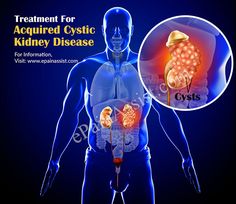 Treatment for Acquired Cystic Kidney Disease (ACKD) Cystic Kidney, Disease