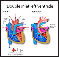 Double Inlet Left Ventricle Nike Air Jordan Shoes, Cardiology, Left And Right, Contact Us, Healing