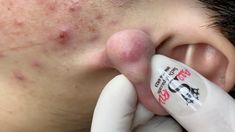 Removing Blackheads From Nose Videos, Holes In Skin Phobia, Hard Pimple, Serums For Acne, Pimple Hacks, Popping Blackheads Youtube Videos, Zit Popping Video Faces, Huge Blackheads, Big Zits