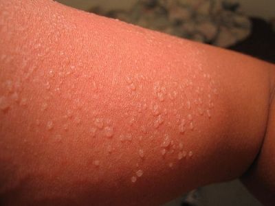 7 Ways to Treat a Sunburn …    I love summer time; the warmer weather, blue skies, swimming in the lake, going fishing, and taking part in other activities that are best … Sun Blisters, Really Bad Sunburn, Water Blister, Blister Remedies, Sunburn Face, Sunburn Blisters, Get Rid Of Sunburn, Home Remedies For Sunburn, Severe Sunburn