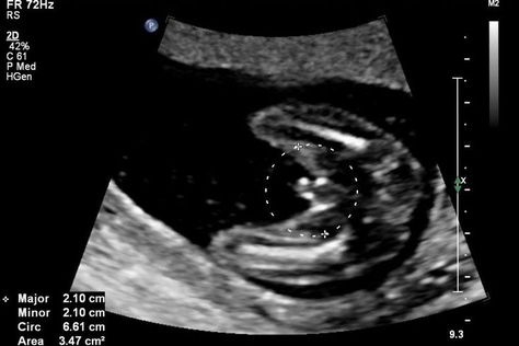 What Does a Baby Boy Look Like on Ultrasound?: Baby Boy at 18 Weeks Ultrasound Boy Or Girl, 15 Week Ultrasound, Boy Ultrasound Pictures, Baby Gender Ultrasound, Girl Ultrasound, Boy Ultrasound, 16 Weeks Pregnant Ultrasound, Gyn Ultrasound, Ultrasound Gender