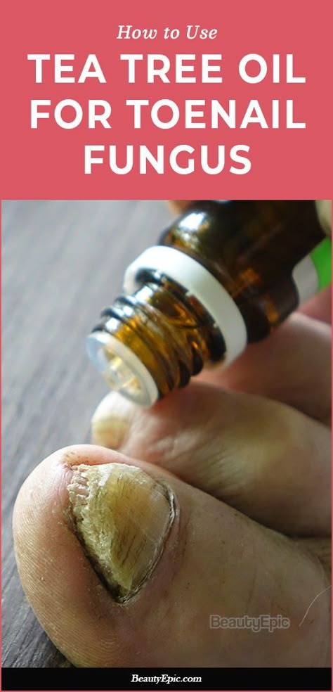 Nail Fungal Infection Toenails, Toe Nail Fungal Infection, Nail Fungus Remedies, Toenail Fungal Infection, Nail Remedies, Natural Antifungal, Nail Fungus Remedy, Toenail Fungus Remedies, Nail Infection