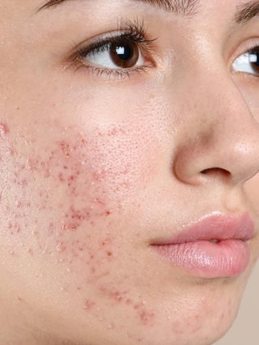 Acne Images, Acne Is Normal, Acne Aesthetic, Acne Pictures, Waxing Vs Shaving, Skin Care Organization, Acne Scar Diy, Home Remedies For Glowing Skin, Acne Positivity