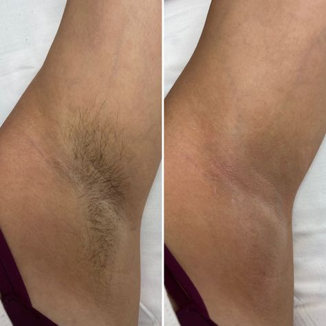 Wax Before After, Waxing Before And After, Body Wax Aesthetic, Waxing Underarms, Waxing Content, Waxing Aesthetic, Waxing Armpits, Female Waxing, Waxing Legs