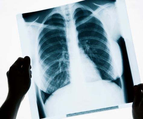 Called ChexNet, an algorithm can accurately diagnose a range of diseases from chest X-rays, reducing human error in radiology with machine learning. Chest X Ray, X Ray Machine, Bad Cough, X-ray Images, How To Help Nausea, Chronic Cough, X Rays, Medical Imaging, Prom Hairstyles For Long Hair