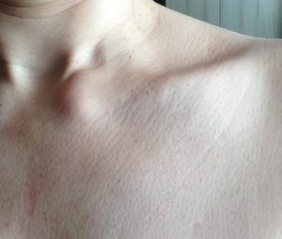 A swollen sterno clavicular joint is usually Tietze's syndrome. I have had a hard lump on my collar bone near my throat, swollen collar bones & sternum Collarbone Anatomy, How To Get Collar Bones, Collar Bone Exercise, Lee Fletcher, Clavicle Bone, Beauty Bone, Lump In Throat, Lb Logo, Neck Bone