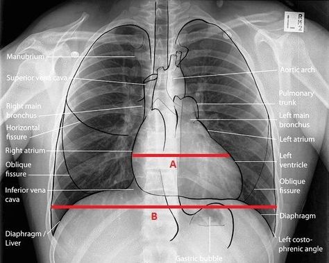 Chest Xray, Radiology Student, Medical Study, Radiology Technologist, Nurse Rock, Respiratory Therapy, Spine Health, Emergency Nursing, Rad Tech