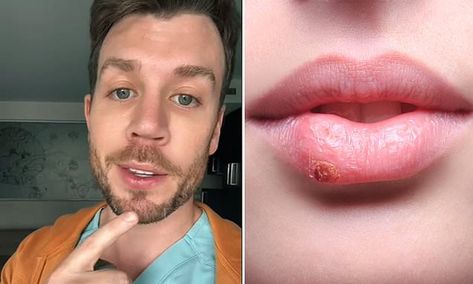 Doctor reveals clever hack to make your cold sores vanish quicker