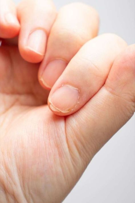 One of the most common types of nail abnormalities is brittleness. #TuesdayTips Learn how to care for them in our blog. Brittle Nails Causes, Essential Oils For Brittle Nails, What To Do For Brittle Nails, Cracked Nails, Brittle Nails, Dermatology, Types Of Nails, Self Care Routine, Nails