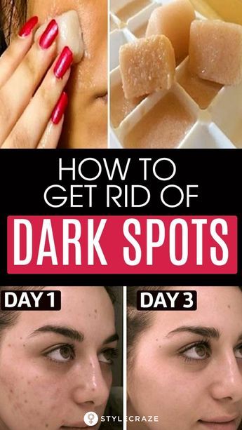 Black Spots On Face, Brown Age Spots, Brown Spots On Skin, Acne Dark Spots, Dark Spots On Face, Brown Spots Removal, Brown Spots On Face, Dark Spots On Skin, Skin Spots