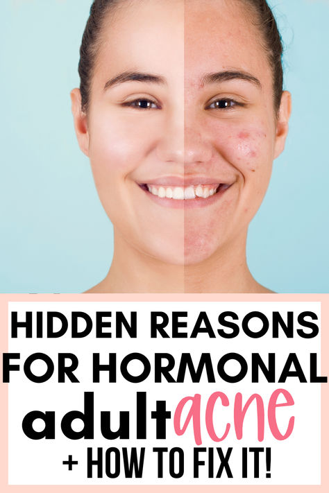 #acne #acnetreatment #naturalacnetreatment Stop Hormonal Acne, How To Get Rid Of Hormonal Acne Fast, Prevent Acne Tips, How To Treat Hormonal Acne Naturally, How To Deal With Hormonal Acne, Acne Zones On Face, How To Control Hormonal Acne, Acne At Age 40, Deep Acne Remedies