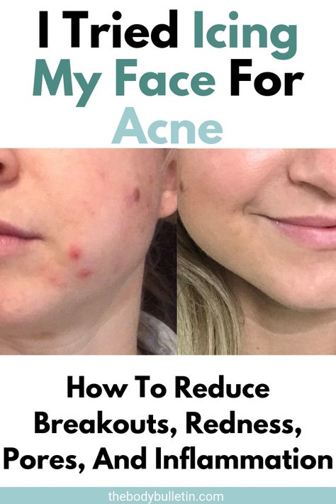 Does ice on acne help? Icing your face benefits include reducing redness, inflammation, and breakouts. Here's what you can expect if you ice your face for acne. Acne Inflammation Remedies, Does Ice Help Pimples, Face Redness Remedy Diy, Is Ice Good For Your Face, Ice For Acne, Reduce Redness In Face Acne, Breakouts On Face Remedies, Face Inflammation Remedies, Ice Therapy Face