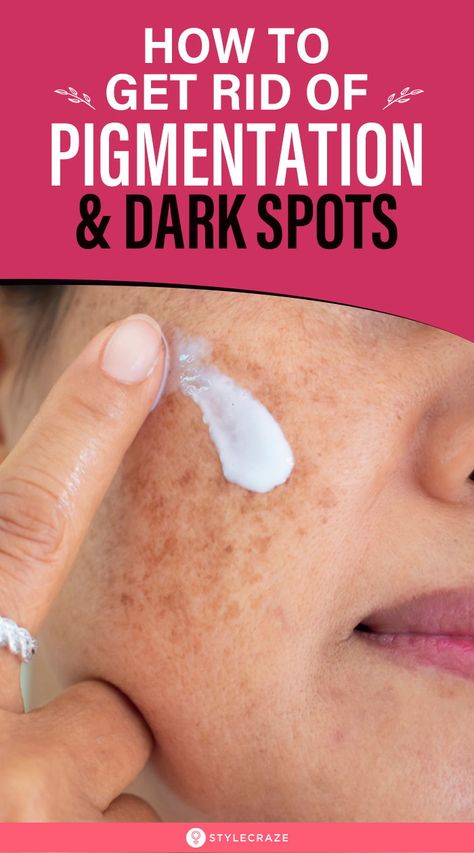 Pigmentation Remedy, Dark Spots Remedies, Brown Spots On Skin, Home Remedies For Skin, Dark Spots On Face, Skin Pigmentation, Brown Spots Removal, Brown Spots On Face, Dark Spots On Skin