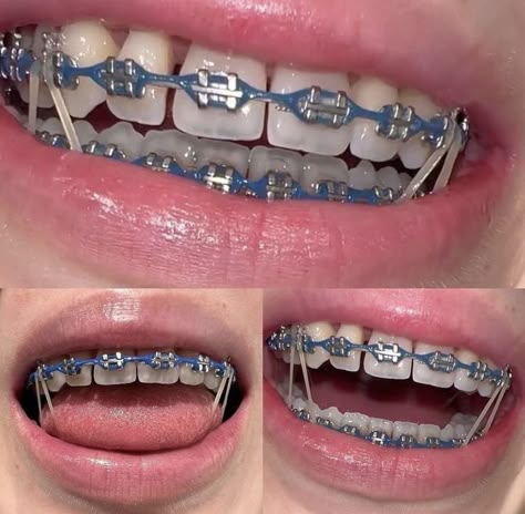 Midnight Glow Braces, Braces Chain Colors, Silver Power Chain Braces, Color Of Braces Ideas, Braces Colors For Latinas, Teeth Braces Colors, Power Chain Braces Colors, Brace Colors Ideas, Braces Aesthetic Colors