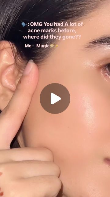 Zarnab🤍 | Yes its true , Acne marks ko ap hamesha k leay by by kr skty and can get glass skin , srf remedies use kr k😍♥️✨  I started series of daily... | Instagram Homemade Remedy For Acne, Remedies For Acne Marks, Remedy For Acne Marks, Products For Acne Marks, How To Remove Acne Marks, Acne Marks Remedies, Daily Skin Care Routine Steps, Acne Pictures, Acne Prone Skin Care Routine