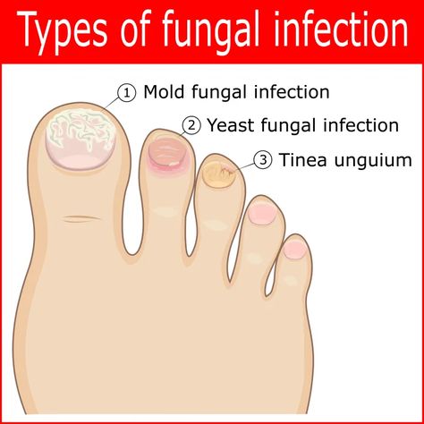 Blog 20 - What Kills Toenail Fungus Instantly? Toenail Pain, Toe Nail Fungal Infection, Infected Toenail, Toenail Fungal Infection, Nail Falling Off, White Toes Nail, Fingernail Fungus, Nail Room Ideas, Emerald Nails