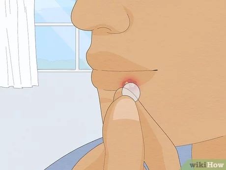 How To Get Rid Of A Cold Sore Fast, How To Get Rid Of Cold Sores Overnight, Cold Sore Remedy Fast, Cold Sore Remedy Overnight, Cold Sore Stages, Cold Sore Remedy, Cold Sore Relief, Pinkeye Remedies, Aloe Vera For Sunburn