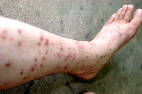 The Clinical Significance And Manifestations Of Sand Fly Fever And Yellow Fever As Arboviral Infections Flea Bites On Humans, Fleas On Cats, Bug Bite Itch, Sand Fleas, Dr Bones, Spanish Mackerel, Bug Bite, Medication Storage, Types Of Diseases