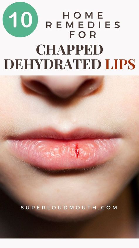 10 Home remedies you can try for dry and dehydrated Lips Remedies For Chapped Lips, Dehydration Remedies, Dry Lips Remedy, Chapped Lips Remedy, Dehydrated Lips, Lip Care Tips, Natural Remedies For Migraines, Home Remedies For Skin, Lip Care Routine