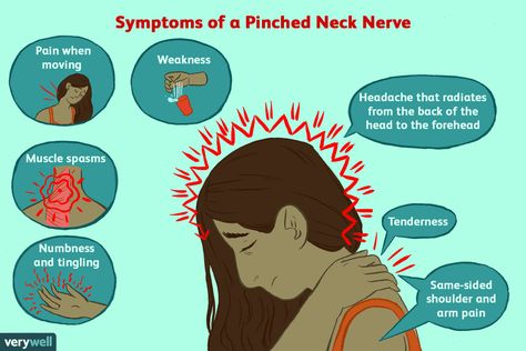 Pinched Nerve In Shoulder, Pinched Nerve Relief, Pinched Nerve In Neck, Nerve Stretches, Neck Spasms, Trapped Nerve, Neck Headache, Sciatic Nerve Stretches, Nerve Relief