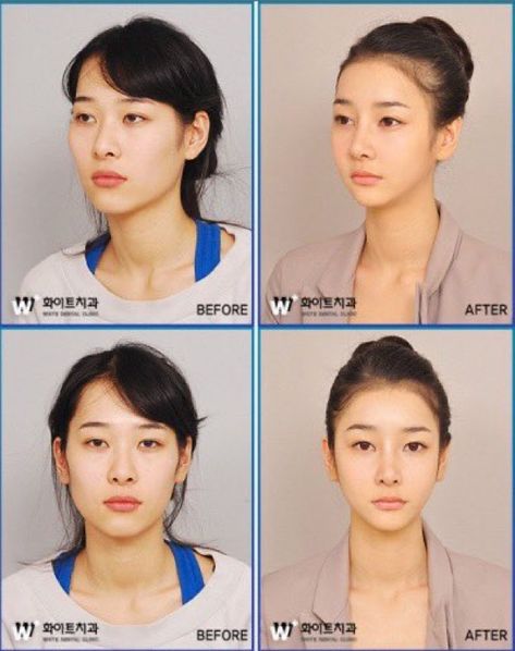 V Shaped Face, Face Symmetry, V Line Surgery, Fenugreek For Hair, Korean Beauty Standards, V Line Face, Korean Plastic Surgery, V Shape Face, Face Surgery