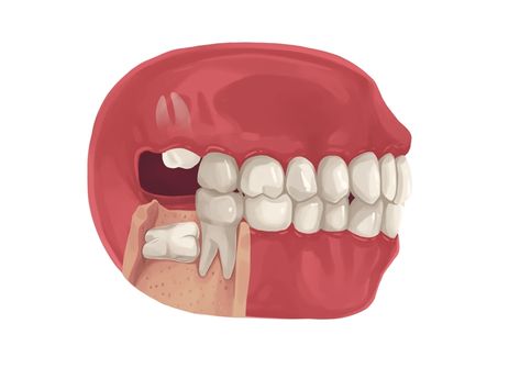 Wisdom Teeth Removal Recovery, Teeth After Braces, Impacted Wisdom Teeth, Teeth Surgery, Cracked Tooth, Dental Extraction, Dental Tips, Wisdom Tooth, Wisdom Tooth Extraction