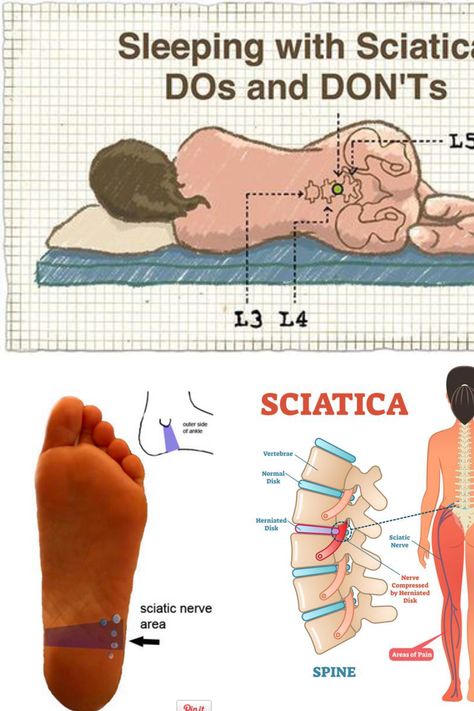 Sciatic Nerve Reflexology Points For Sciatica. http://www.bukisa.com/articles/92752_how-to-foot-massage-for-sciatica#ixzz2N9qJQUk3&i Sacroiliac Pain Relief, Pressure Point For Sciatic Nerve, Essential Oils For Sciatic Nerve Pain, Massage For Sciatica, Exercises For Sciatic Nerve Pain Sciatica Stretches, Nerve Relief, Sciatic Nerve Exercises, Sciatic Nerve Stretches, Sciatic Nerve Relief