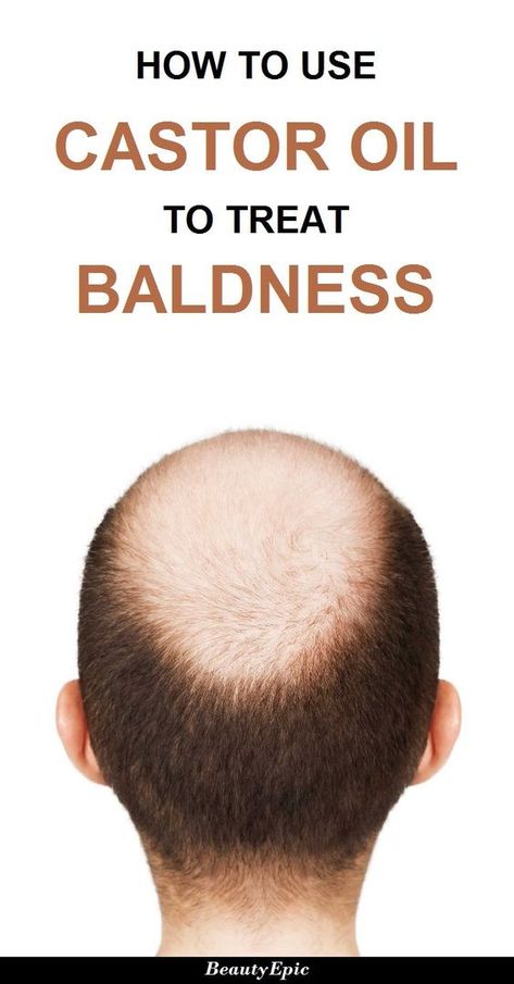 How to Treat Baldness with Castor Oil Baking Soda Shampoo Recipe, Hair Growth For Men, Castor Oil For Hair Growth, Castor Oil For Hair, Home Remedies For Hair, Baking Soda Shampoo, Hair Control, Hair Remedies, Hair Growth Oil