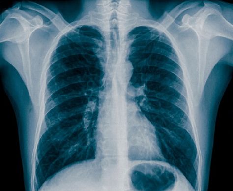 Chest X-Rays: The Role They Play in Asthma Screening and Diagnosis Why a Chest X-Ray is Performed on Asthma Patients What Is Asthma, Medical Drawings, Asthma Remedies, Asthma Relief, Chariots Of Fire, Breath Of Life, Asthma Symptoms, Medical Illustrations, Asthma Attacks