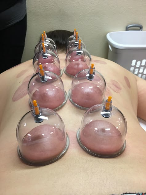 Hijama Cupping Therapy, Foot Massage Techniques, Benefits Of Cupping, Hijama Cupping, Massage Pictures, Massage Cupping, Face Mask Aesthetic, Cupping Massage, Spa Room Decor