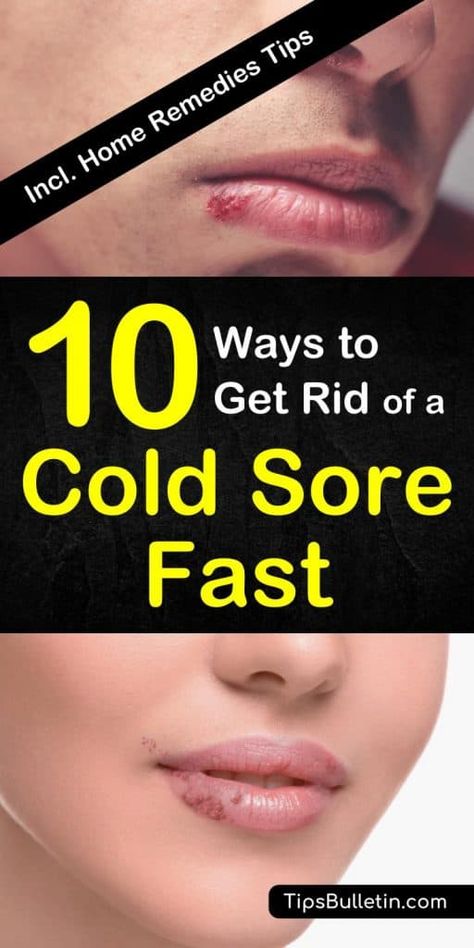 Cold Sore Remedy, Healing Cavities, Natural Add Remedies, Remedy For Cold, Cramp Relief, Fever Blister, Get Rid Of Cold, Cold Sore Remedies, Canker Sore