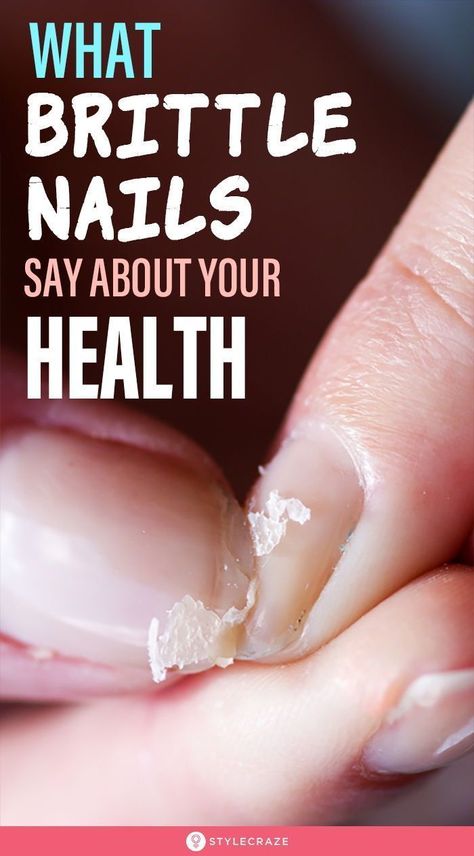 What Brittle Nails Say About Your Health: Brittleness of the nails refers to a condition where nails easily crack, chip, split or even peel off. It’s important to understand that sometimes brittle nails aren’t just something silly, it could be a sign of something serious too. #nails #nailcare #nailcaretips Split Nails, Cracked Nails, Peeling Nails, No Chip Nails, Nail Care Tips, Brittle Nails, Creative Lifestyle, New Nail Art, Nail Fungus